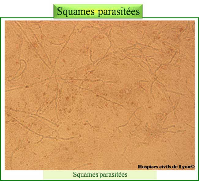 Squames parasitées