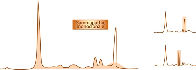 gammapathie monoclonale